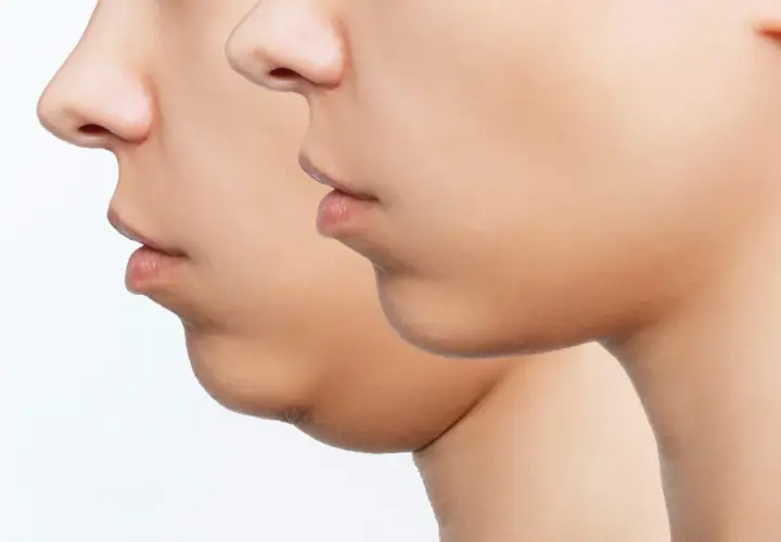 Perfil de un rostro mostrando la reducción de la papada.