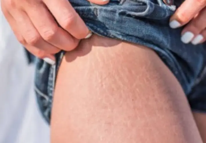 Piel con estrías, un detalle común que muchas mujeres buscan cómo quitar estrías.