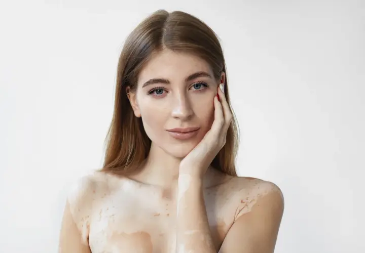 Mujer con vitiligo, su piel muestra áreas despigmentadas. El ácido salicílico para qué sirve: ayuda a exfoliar y mejorar la textura de la piel.