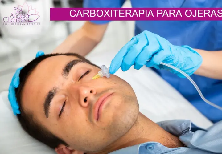 Un profesional aplica carboxiterapia para ojeras a un hombre. El tratamiento mejora la apariencia de la piel.