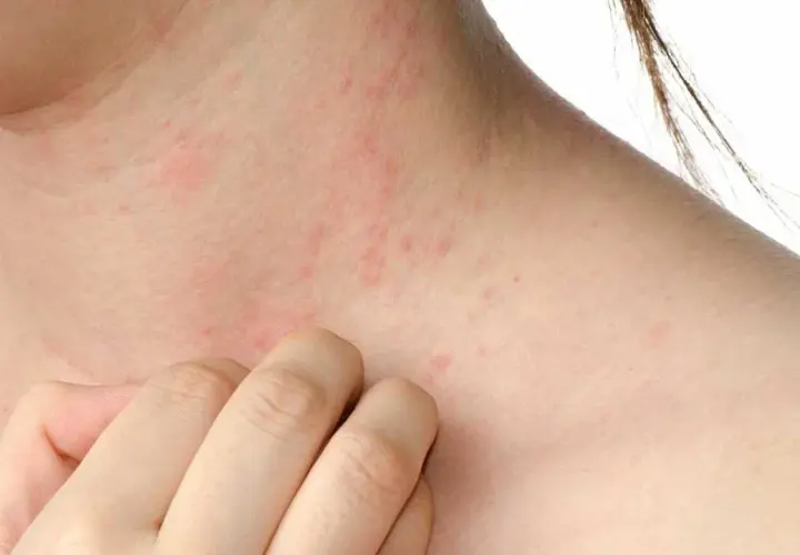 Piel irritada con enrojecimiento y pequeños bultos, indicando posible reacción a ácaros, alergia en la piel.