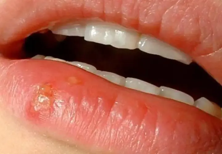 Una llaga en el labio inferior, con pequeñas ampollas y enrojecimiento.