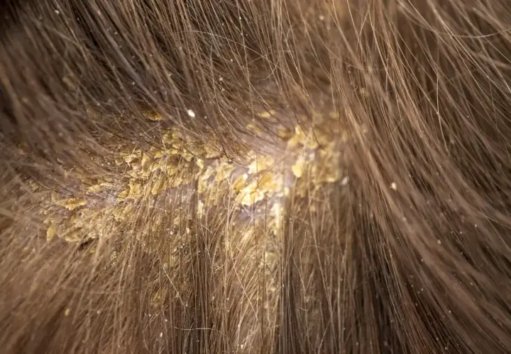 Primer plano de costras amarillentas y escamas en el cuero cabelludo, rodeadas de cabello castaño.