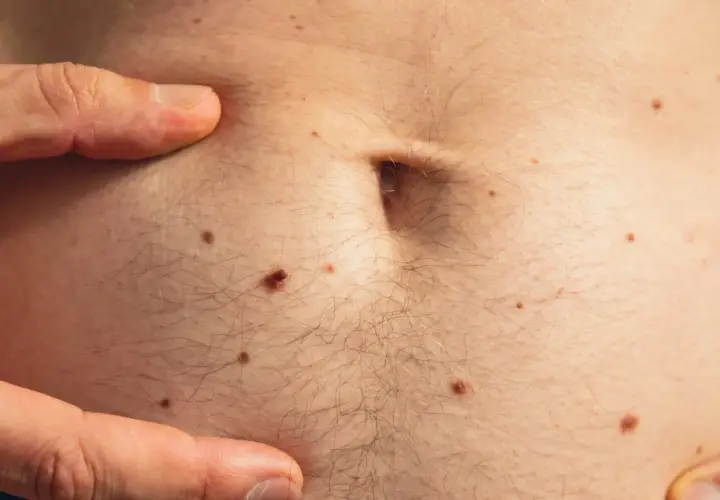 Un dedo señala la piel del abdomen, cubierta de lunares y vello. Se observa un pequeño quiste de grasa.