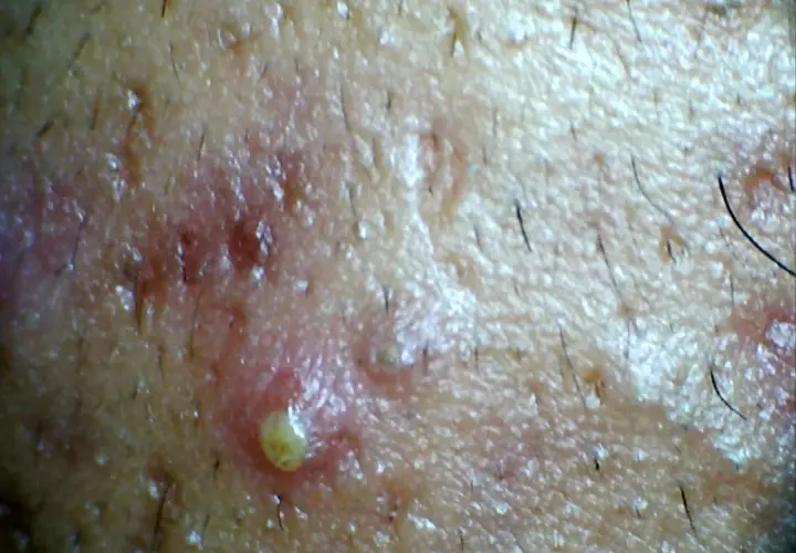 Primer plano de una pustula con pus amarillo, rodeada de piel enrojecida y vello oscuro.