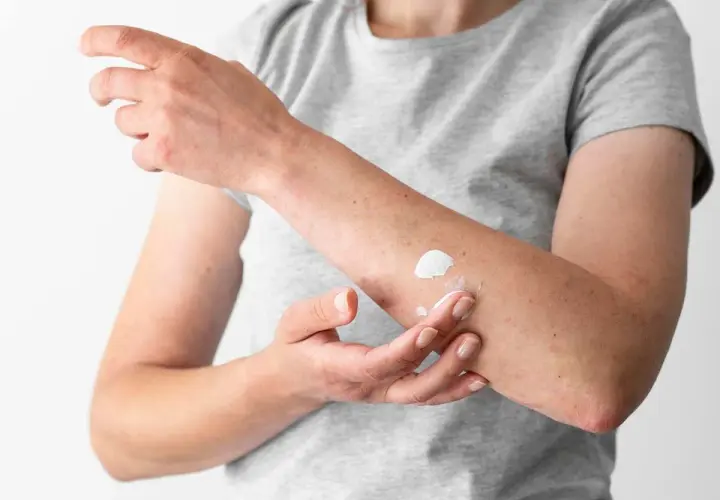 Persona aplica crema en su brazo, quizás para tratar hongos en la piel porque salen por humedad o contacto.