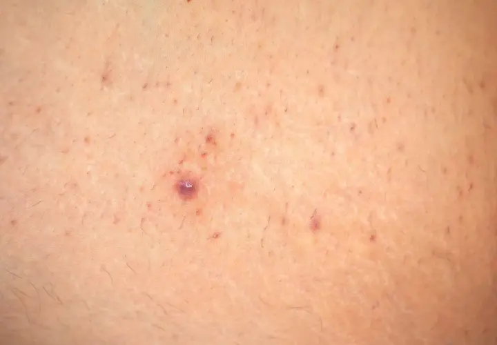 Primer plano de piel con pequeñas imperfecciones y vello fino, con una zona que recuerda a la piel de fresa.