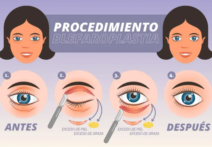 Ilustración del procedimiento de blefaroplastia para corregir párpados caídos, mostrando antes y después.