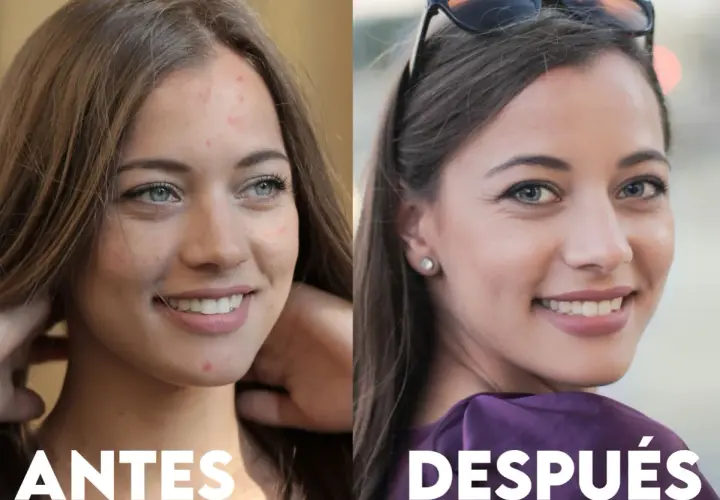 Antes y después de un tratamiento para el acné. La piel de la mujer luce más limpia y radiante, mostrando los beneficios de deripil.