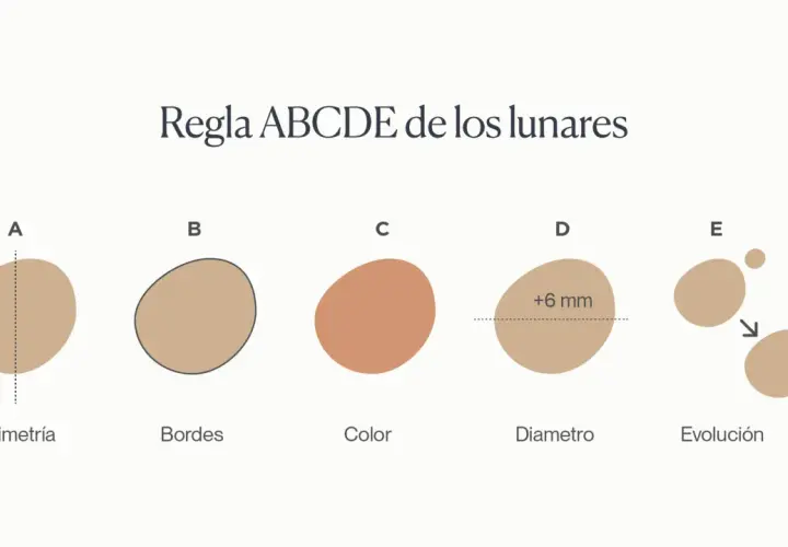 Regla ABCDE para identificar lunares malignos: Asimetría, Bordes irregulares, Color variado, Diámetro mayor a 6mm y Evolución.
