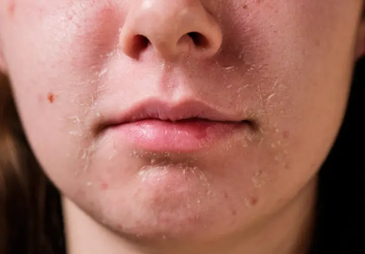 Primer plano de piel facial con descamación y enrojecimiento alrededor de la nariz y la boca.