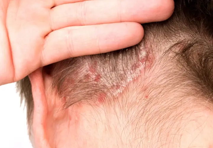 Una mano cubre parte de la cabeza, revelando un cuero cabelludo irritado con enrojecimiento y escamas blancas.