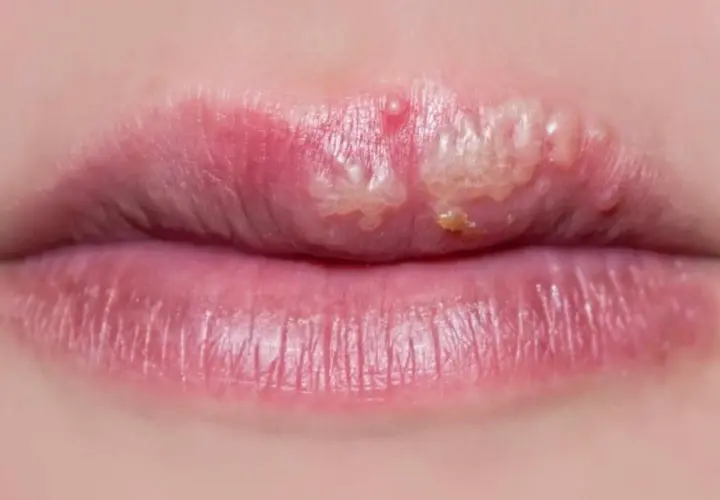 Labios con ampollas y costras, posiblemente tratables con ácido fusídico.