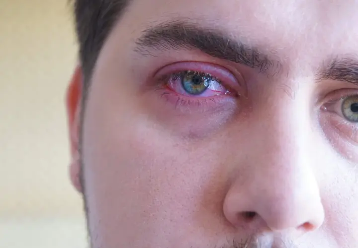Ojo irritado con una pequeña bolita granito en la línea de agua. El párpado está enrojecido y la conjuntiva inflamada.