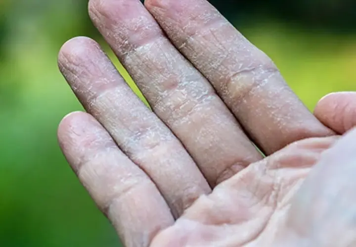 Dedos con piel seca y agrietada, síntoma de dishidrosis.