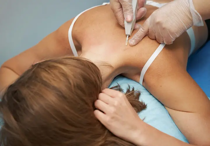 Profesional aplica carboxiterapia corporal en la espalda de una mujer.