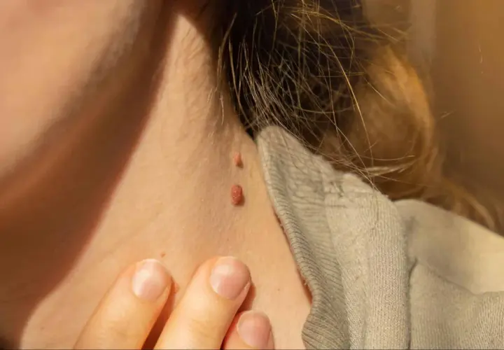Primer plano de dos verrugas en el cuello, una más grande que la otra. Se busca información sobre cómo quitar verrugas cuello.