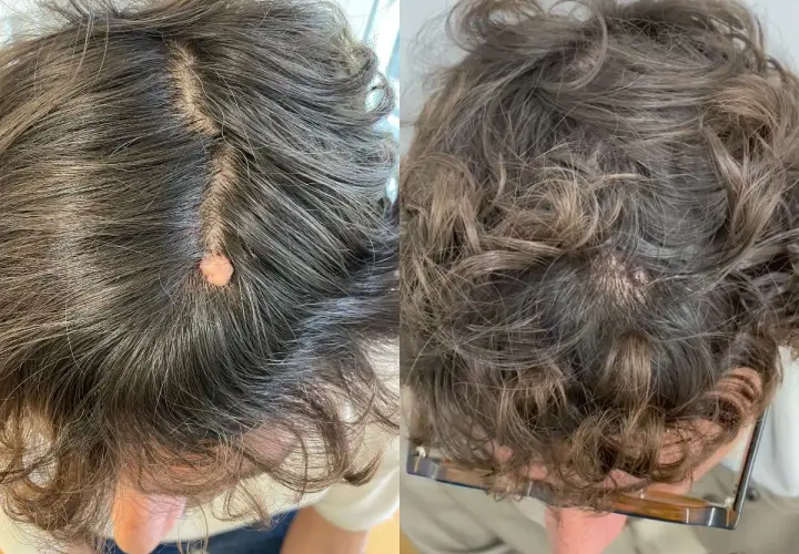 Comparación de verrugas en la cabeza antes y después del tratamiento.