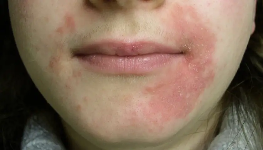 Piel enrojecida y con escamas alrededor de la boca, indicativo de dermatitis perioral. El tratamiento es clave para aliviar la irritación.