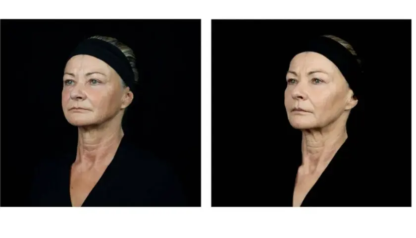 Dos retratos de perfil de una mujer mayor con banda negra, mostrando su piel.