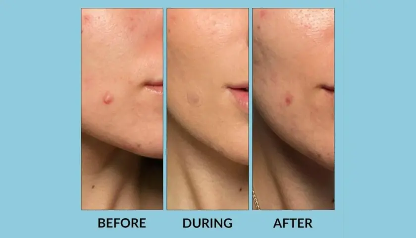 Tres imágenes de un rostro mostrando la evolución de un grano. Antes, durante con un parche de hidrocoloide, y después, con el grano reducido.