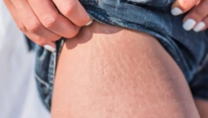 Piel con estrías, un detalle común que muchas mujeres buscan cómo quitar estrías.