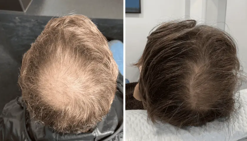 Comparación de la densidad capilar antes y después de la enzimoterapia. Se observa una mejora notable en el crecimiento del cabello.