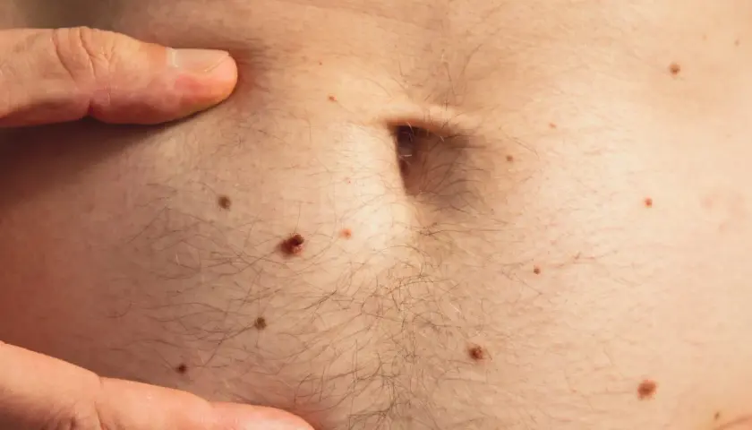 Un dedo señala la piel del abdomen, cubierta de lunares y vello. Se observa un pequeño quiste de grasa.