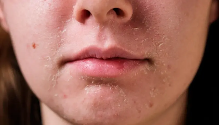 Primer plano de piel facial con descamación y enrojecimiento alrededor de la nariz y la boca.