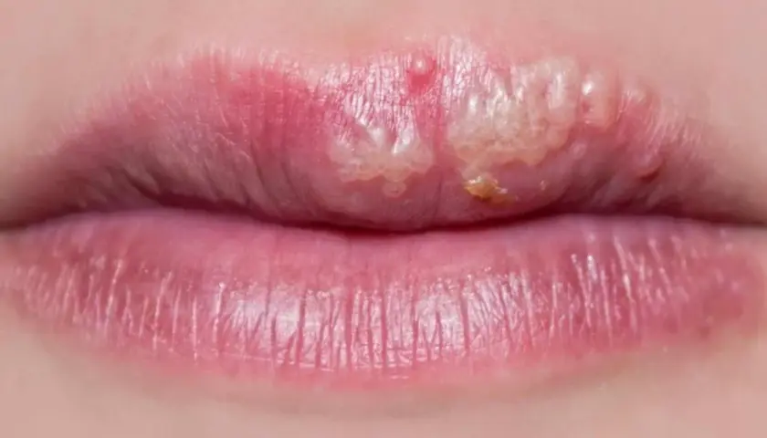Labios con ampollas y costras, posiblemente tratables con ácido fusídico.