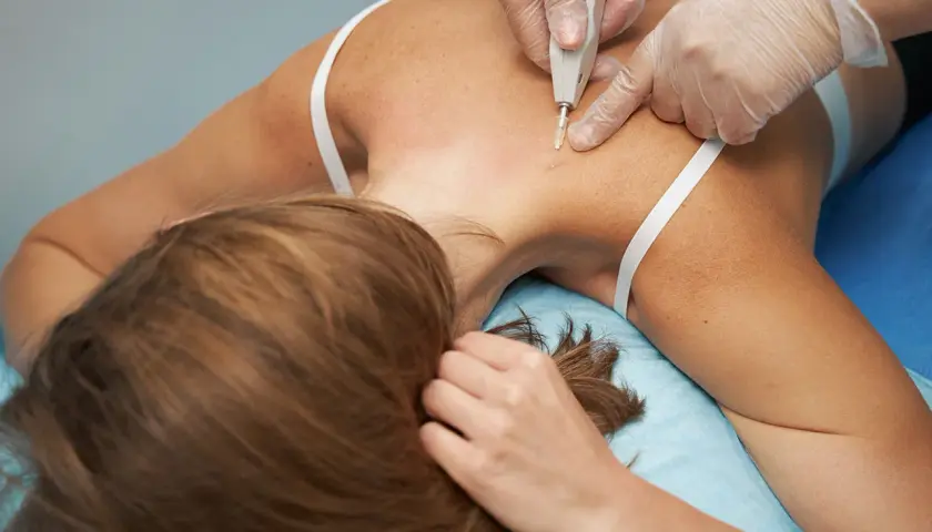 Profesional aplica carboxiterapia corporal en la espalda de una mujer.