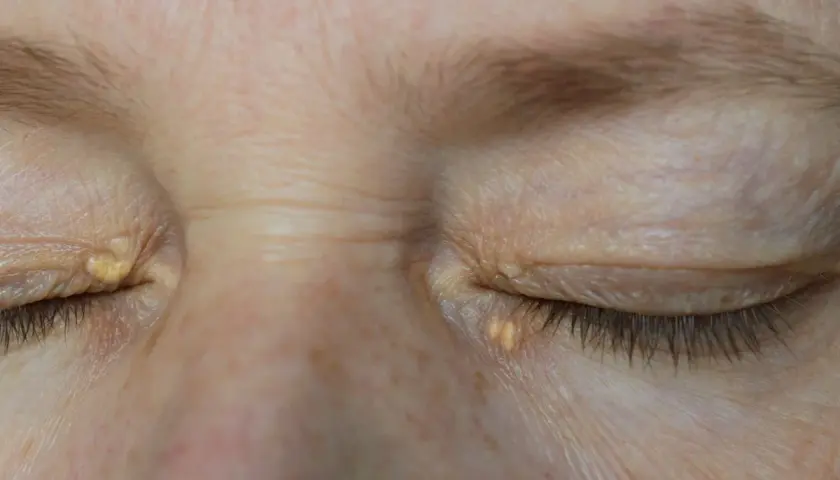 Párpados con xantelasma, depósitos amarillentos de colesterol cerca de los ojos.