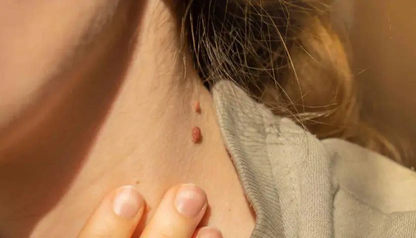 Primer plano de dos verrugas en el cuello, una más grande que la otra. Se busca información sobre cómo quitar verrugas cuello.