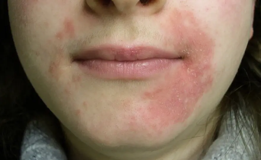 Dermatitis perioral - qué la empeora y cómo mejorarla