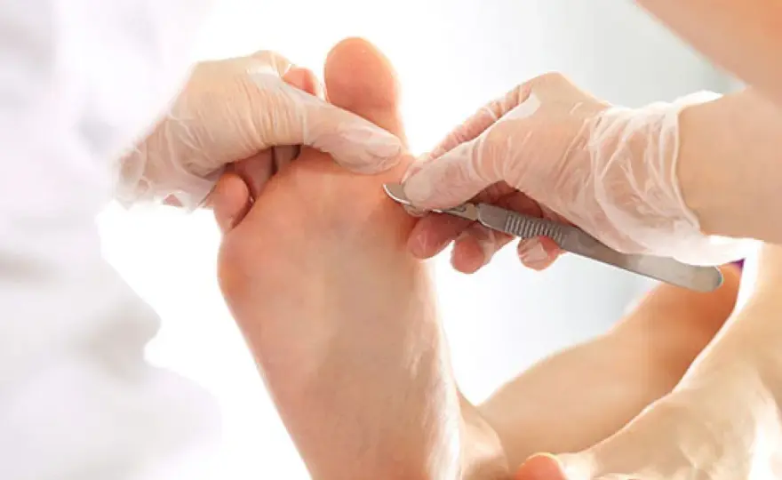 Callos en los pies - cómo tratarlos sin empeorarlos