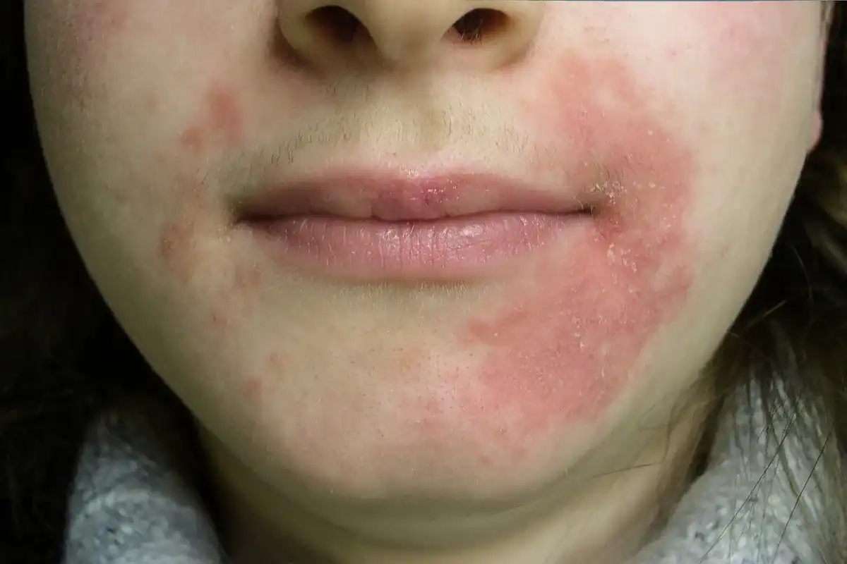 Dermatitis perioral - qué la empeora y cómo mejorarla