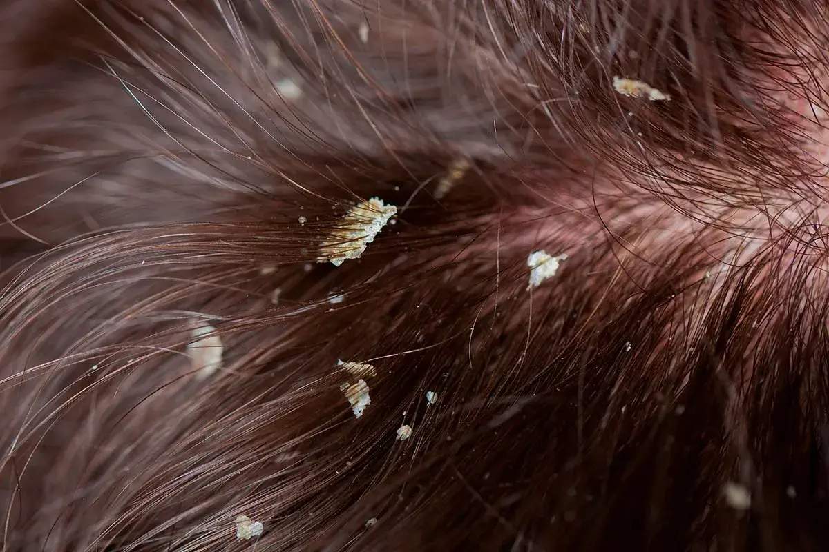 Primer plano de descamación cuero cabelludo con hebras de cabello castaño.