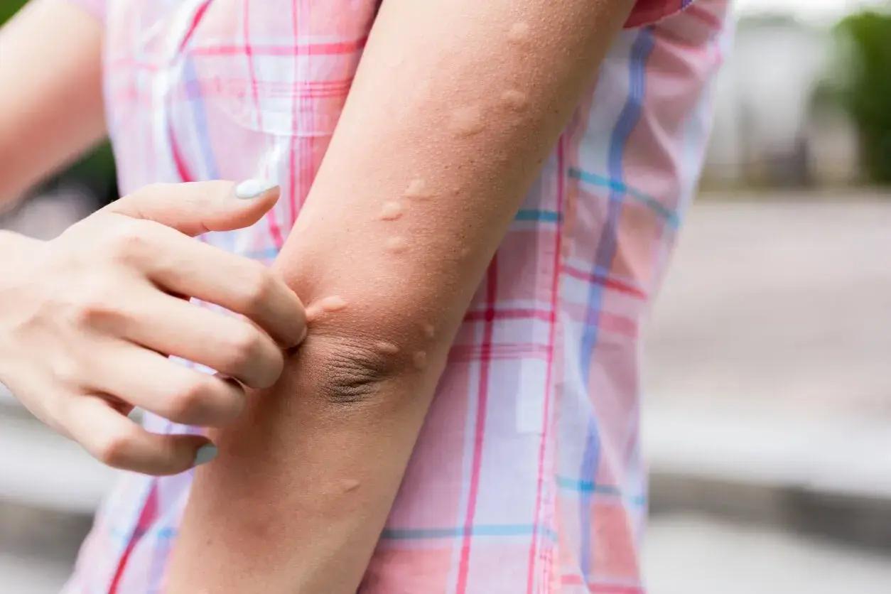 Brazo con ronchas rojas y elevadas, una mano se rasca la piel.