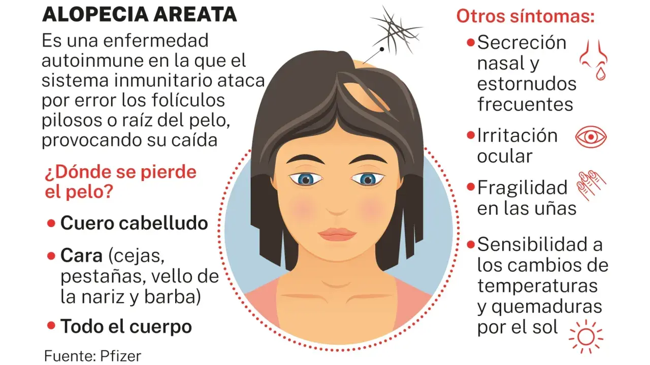 Ilustración de una mujer con alopecia areata, mostrando la pérdida de cabello en el cuero cabelludo y otros síntomas.