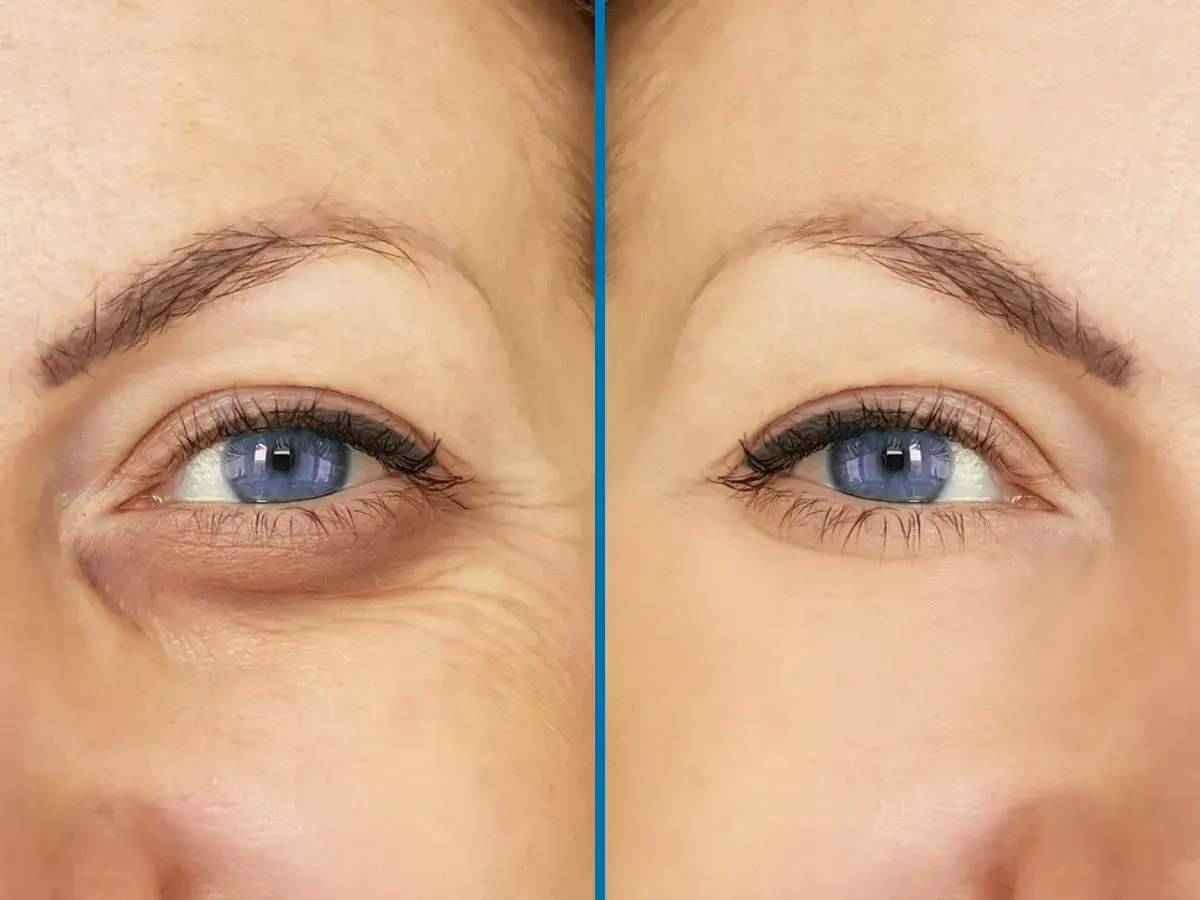 Ojos con ojeras hundidas y arrugas antes y después de un tratamiento.
