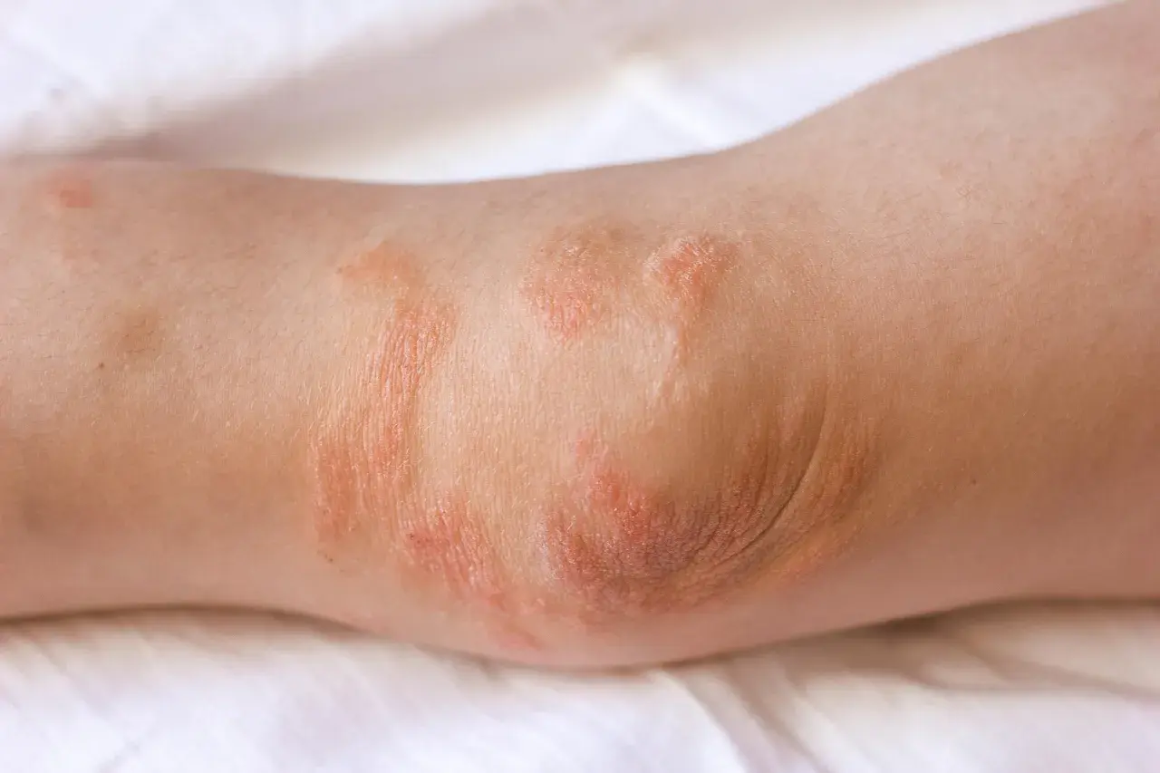 Codo con parches rojos y escamosos, indicativos de eczema. La piel está irritada y seca.