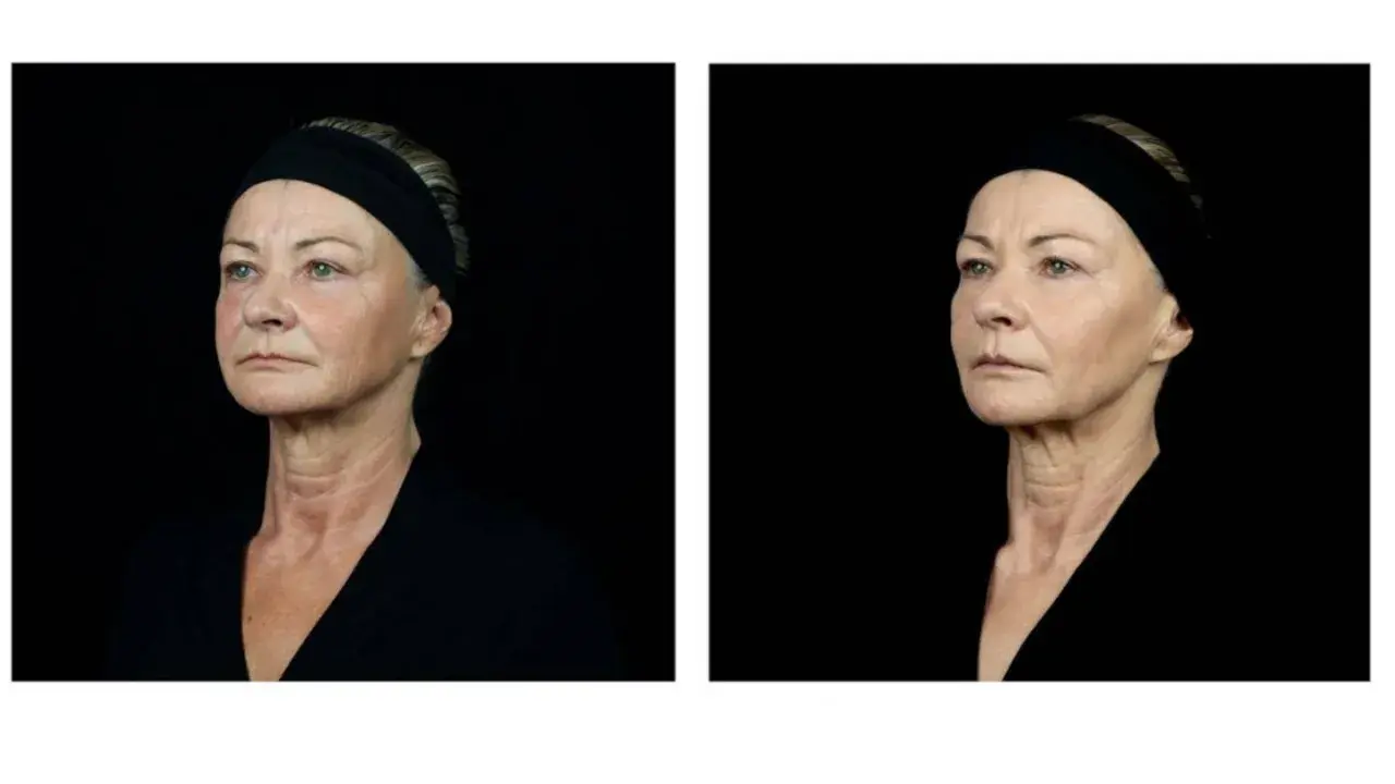 Dos retratos de perfil de una mujer mayor con banda negra, mostrando su piel.