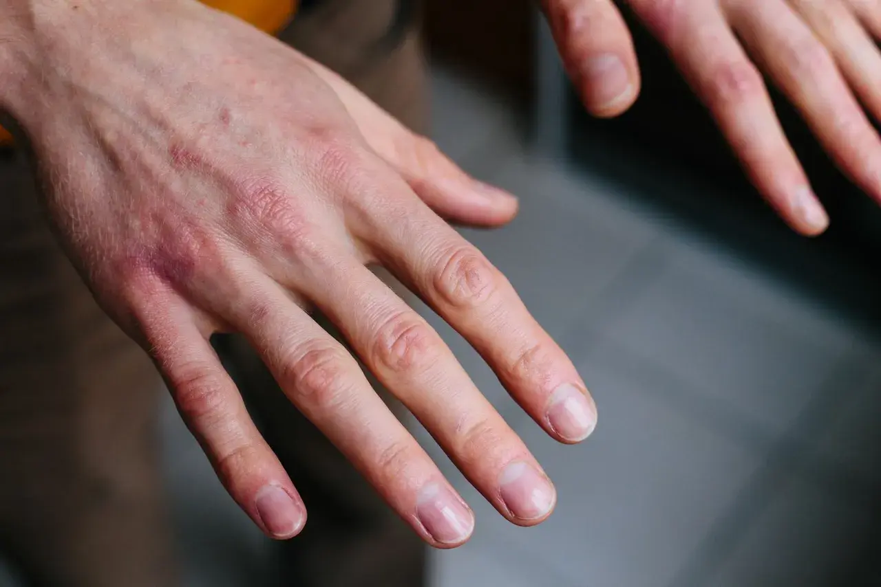 Manos con sabañones, piel enrojecida y seca en los nudillos, indicando posible irritación o frío.