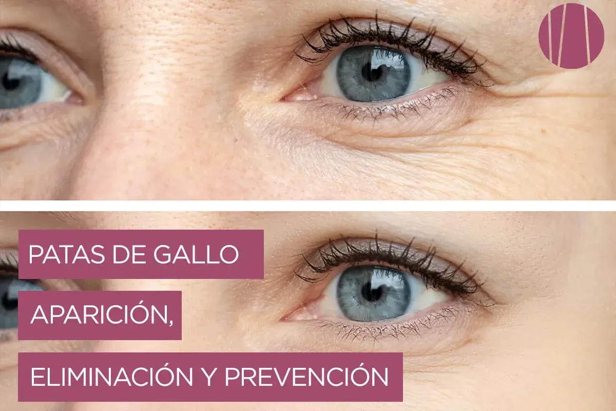 Ojos con y sin **patas de gallo**. La imagen superior muestra arrugas marcadas, mientras que la inferior, con piel más lisa, ilustra la eliminación y prevención.