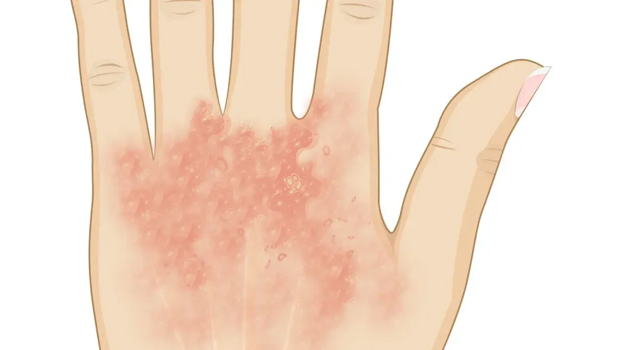 Ilustración de una mano con dermatitis, mostrando enrojecimiento y ampollas.