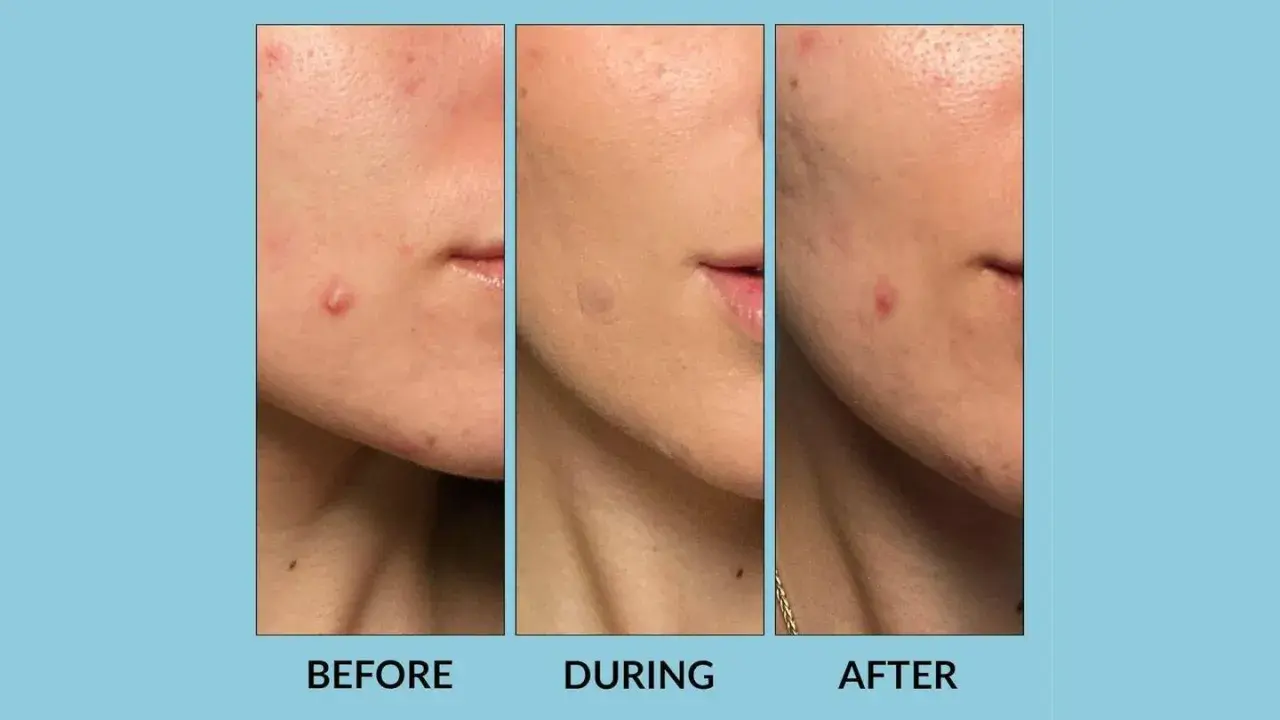 Tres imágenes de un rostro mostrando la evolución de un grano. Antes, durante con un parche de hidrocoloide, y después, con el grano reducido.