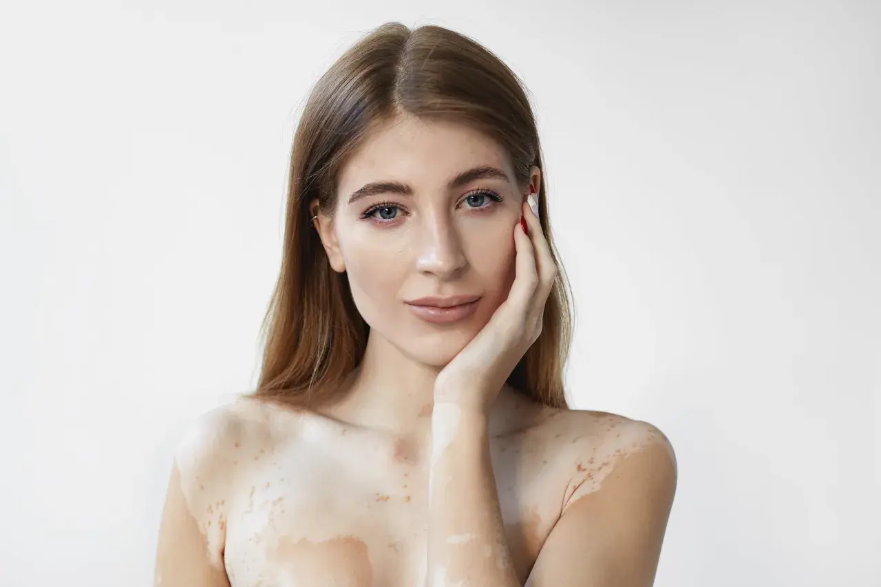 Mujer con vitiligo, su piel muestra áreas despigmentadas. El ácido salicílico para qué sirve: ayuda a exfoliar y mejorar la textura de la piel.