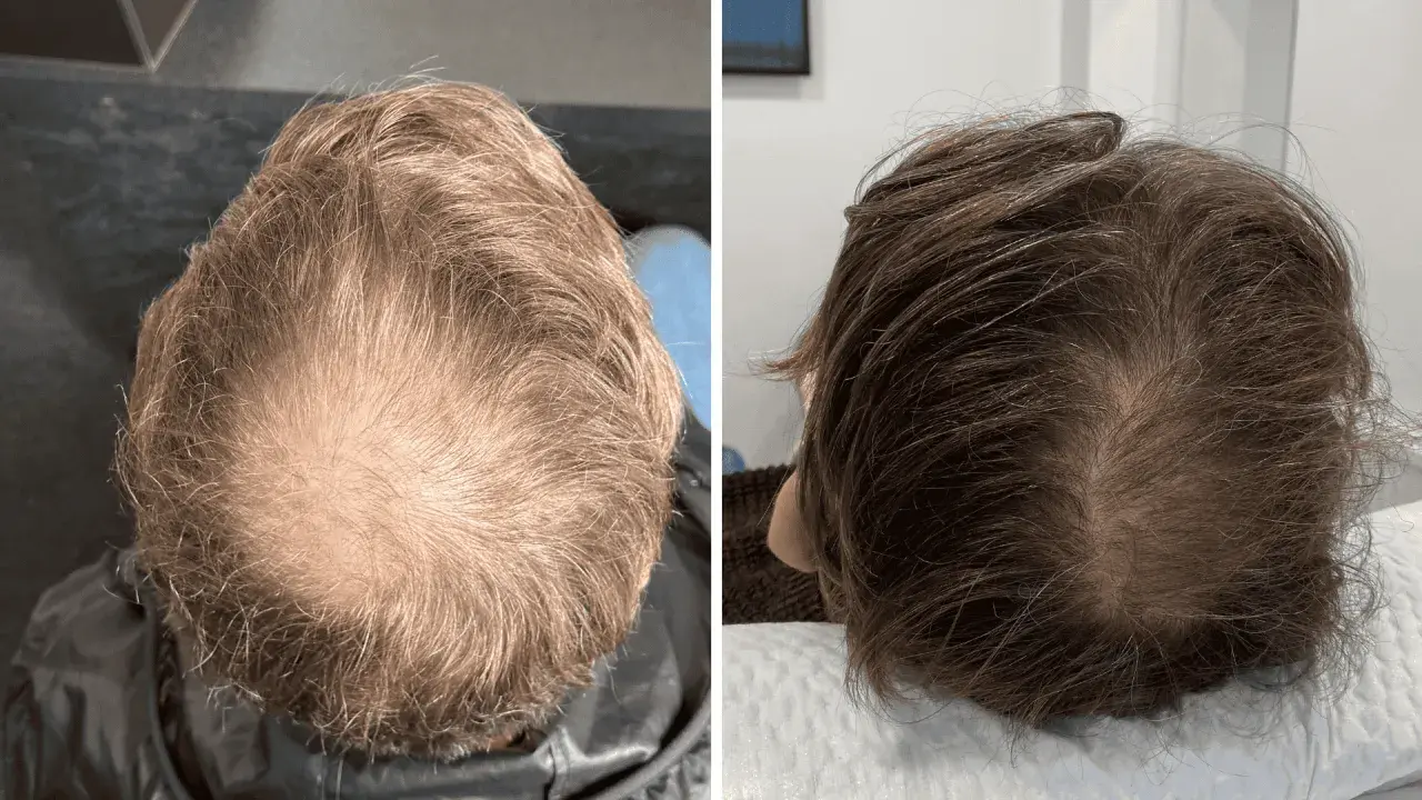 Comparación de la densidad capilar antes y después de la enzimoterapia. Se observa una mejora notable en el crecimiento del cabello.