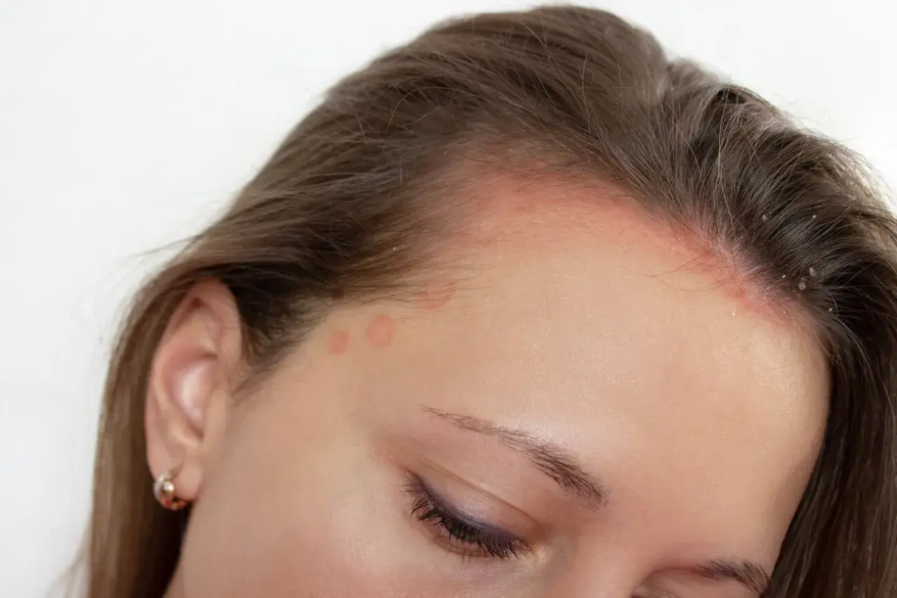 Marcas rojizas y escamas en la frente y cuero cabelludo, indicativo de dermatitis seborreica.