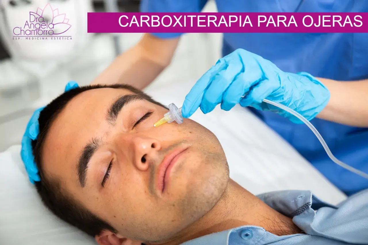 Un profesional aplica carboxiterapia para ojeras a un hombre. El tratamiento mejora la apariencia de la piel.